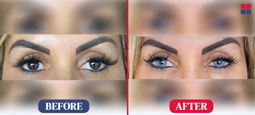 Patient Before After Eye Color Change