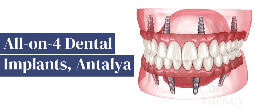 All-on-four dental implants Turkey
