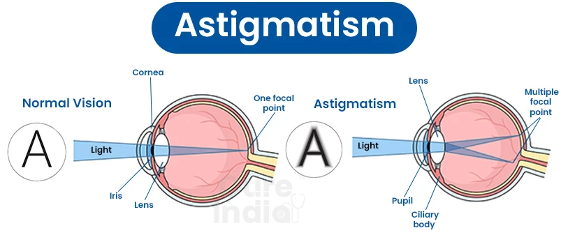 Different Types of Astigmatism