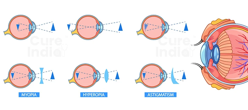 How Does Astigmatism Affect Vision
