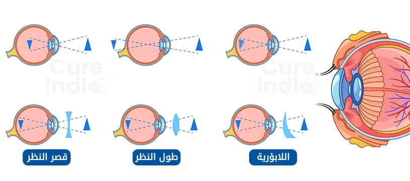 الاستجماتيزم