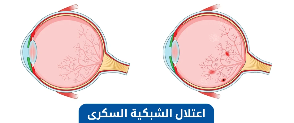 اعتلال الشبكية السكرى