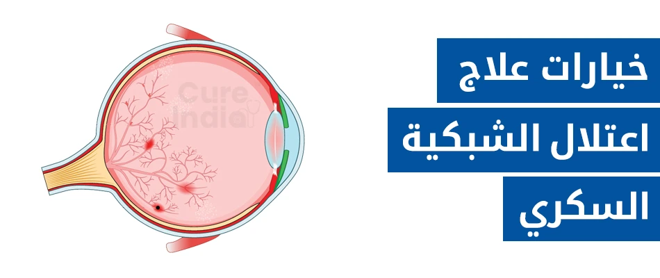 خيارات علاج اعتلال الشبكية السكري