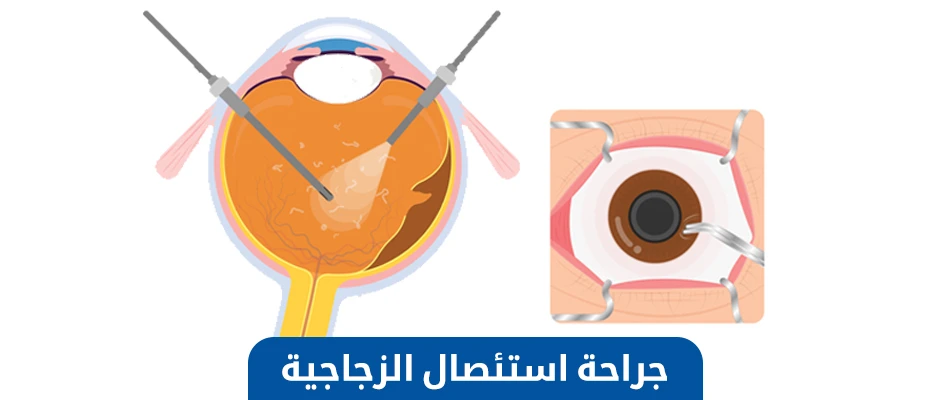 ما هي عملية استئصال الزجاجية