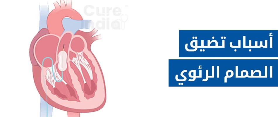 أسباب تضيق الصمام الرئوي