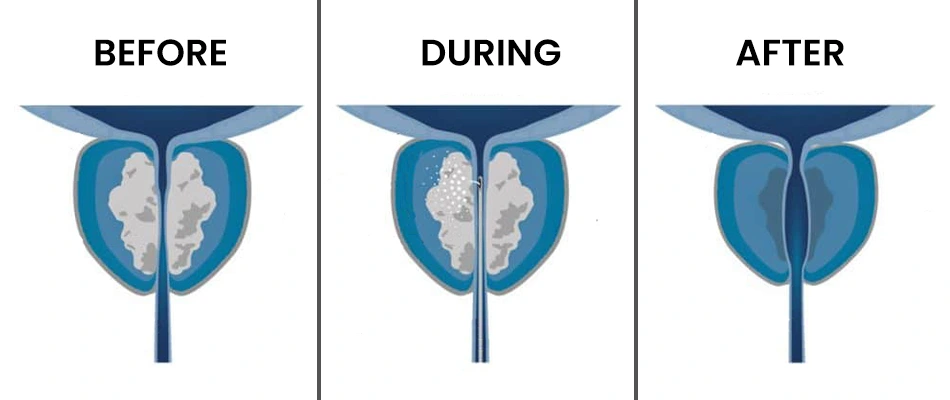 What is Rezum Water Vapor Therapy?