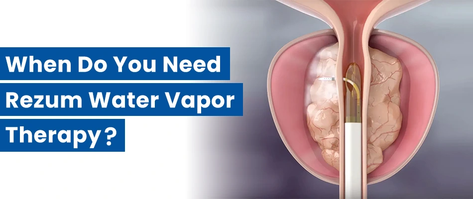 When is Rezum Water Vapor Therapy Needed?