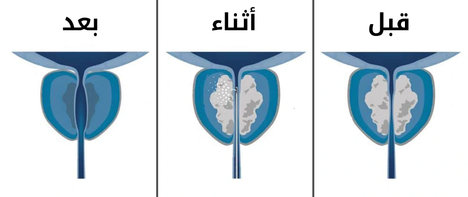 ما هي عملية الريزوم