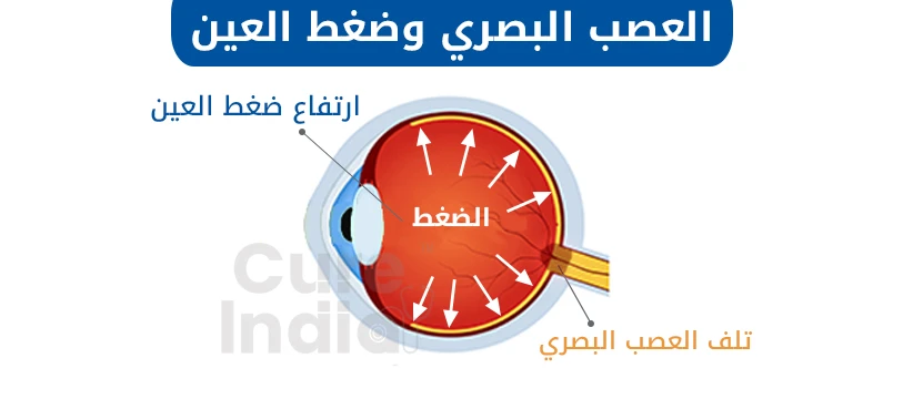 العصب البصري وضغط العين