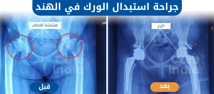 ما هي جراحة استبدال مفصل الورك