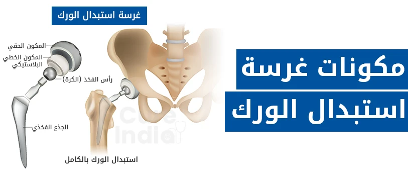 مكونات مفصل الورك البديل
