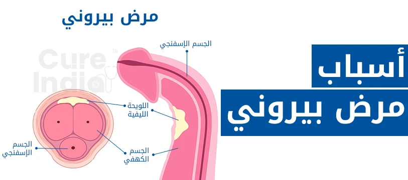 اسباب مرض بيروني