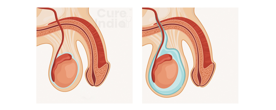 What is a Hydrocelectomy