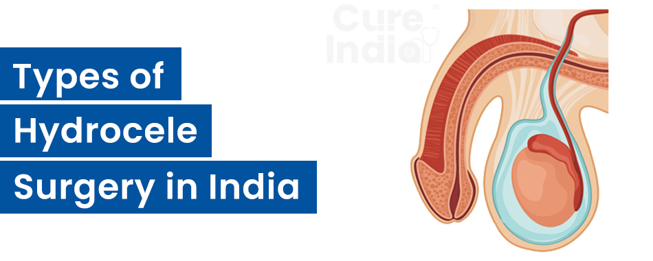 Types of Hydrocele Surgery in India 