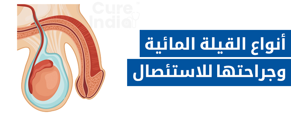 أنواع القيلة المائية وجراحتها للاستئصال