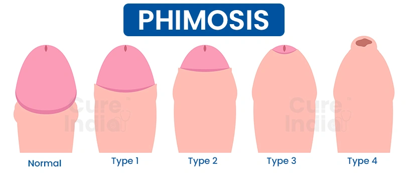 What is Phimosis?