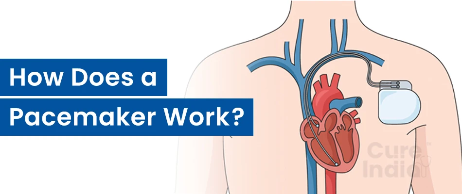 How Does a Heart Pacemaker Work?