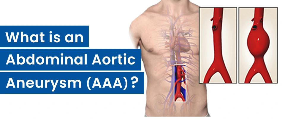 What is an Abdominal Aortic Aneurysm?