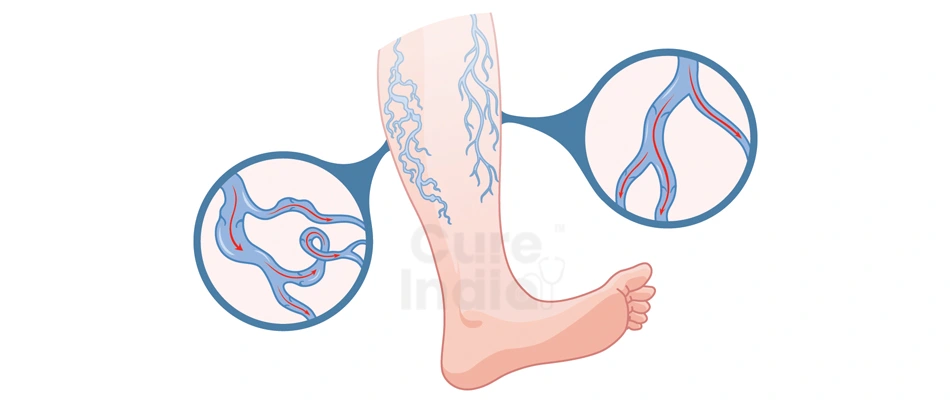 What is Varicose Veins