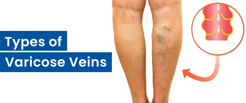 Types of Varicose Veins
