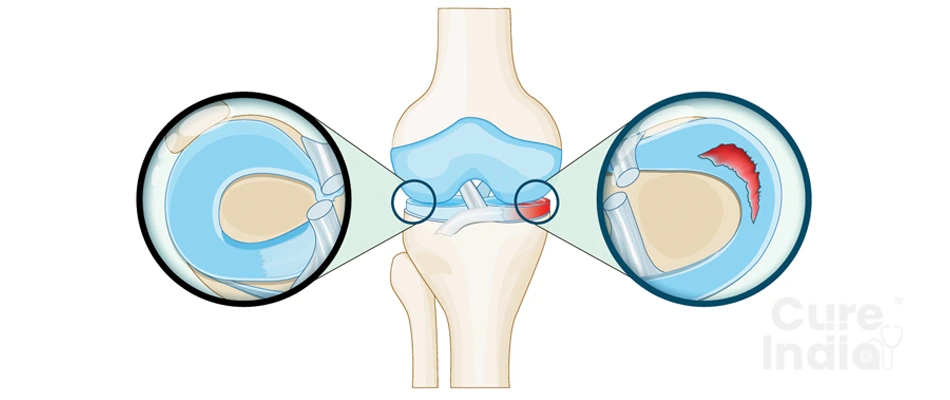 What is a Meniscus Tear