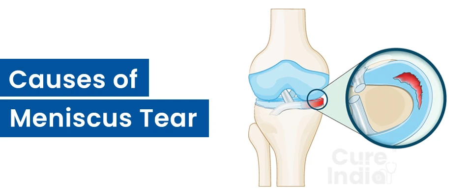 Causes of Meniscus Tear