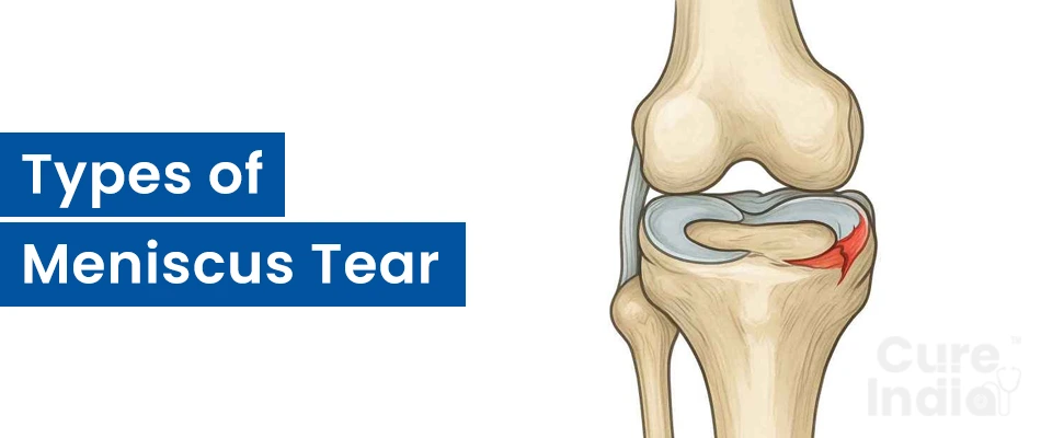 Types of Meniscus Tear
