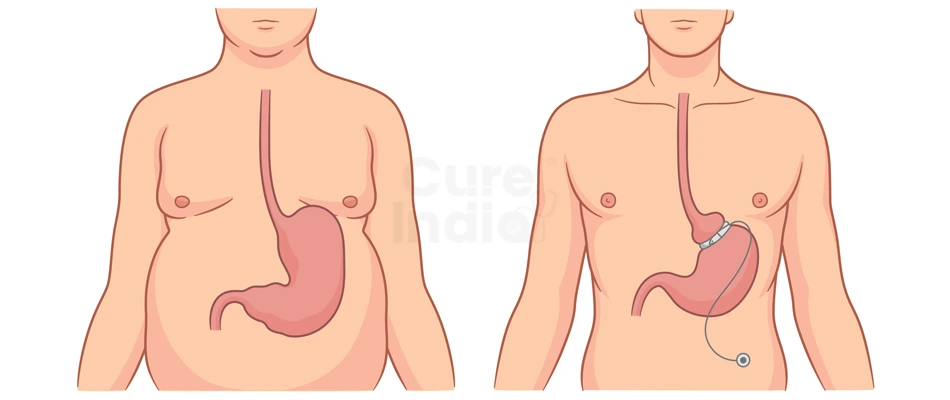 What is Adjustable Gastric Band