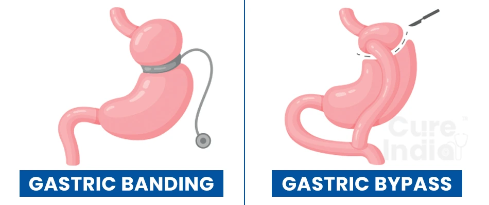 Gastric Banding Vs. Gastric Bypass Surgery