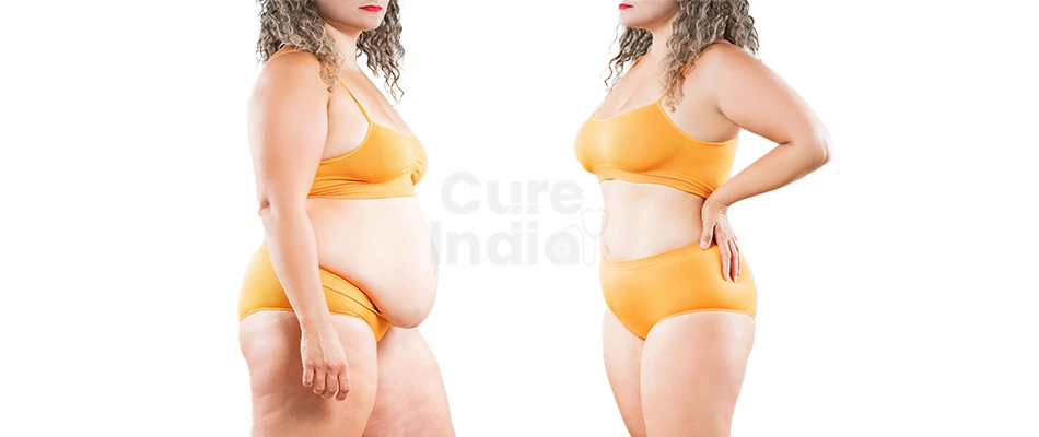 Weight Loss Surgery Procedure in India