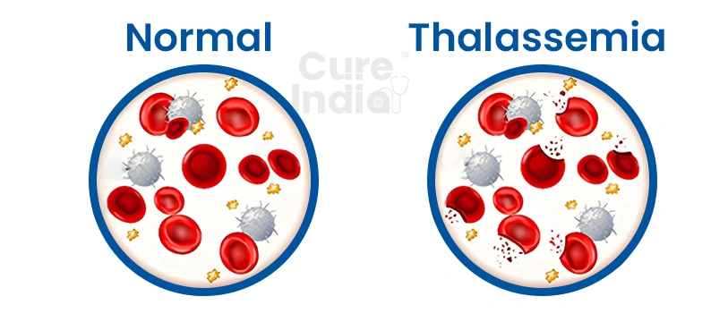 What is Thalassemia?