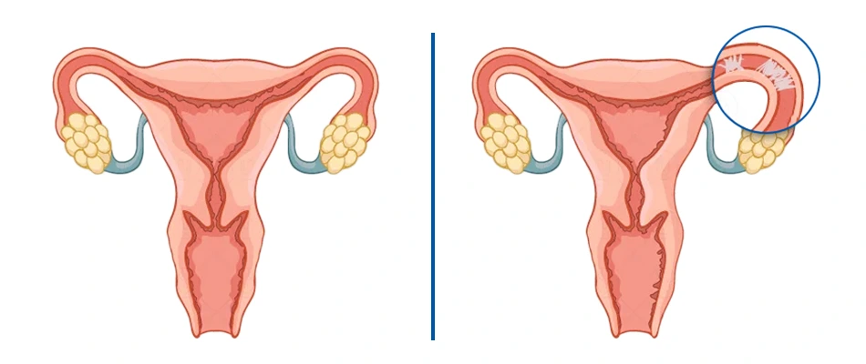 What is Fallopian Tube Blockage