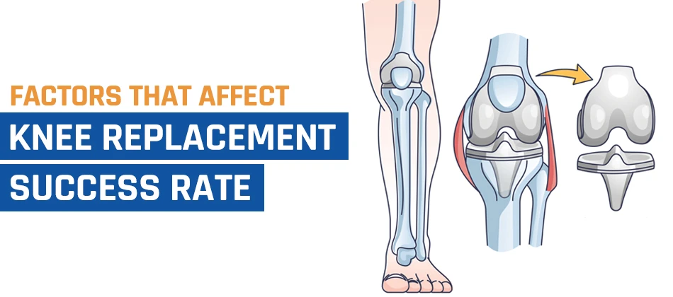 What Factors Can Affect Your Knee Replacement Success Rate