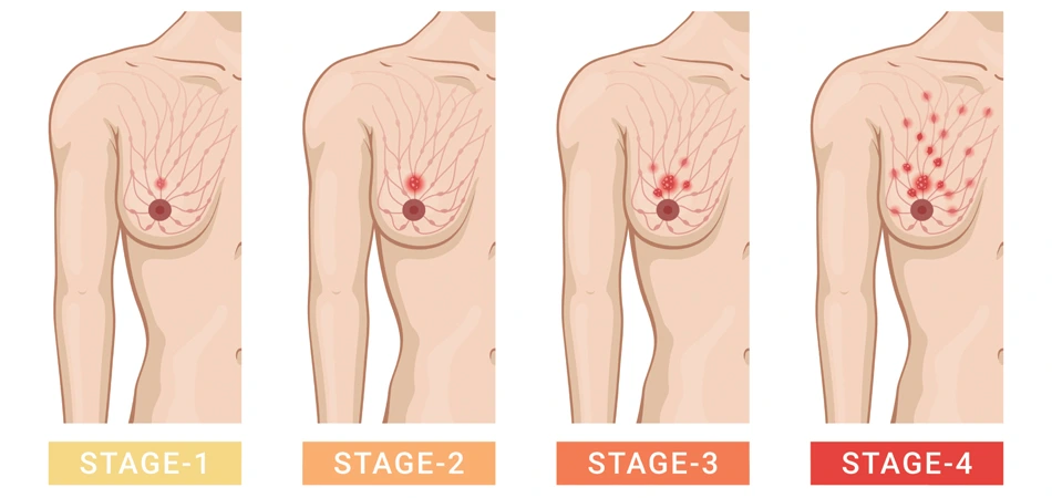 Breast Cancer Survival by Stage