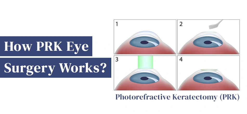 How PRK Eye Surgery Works