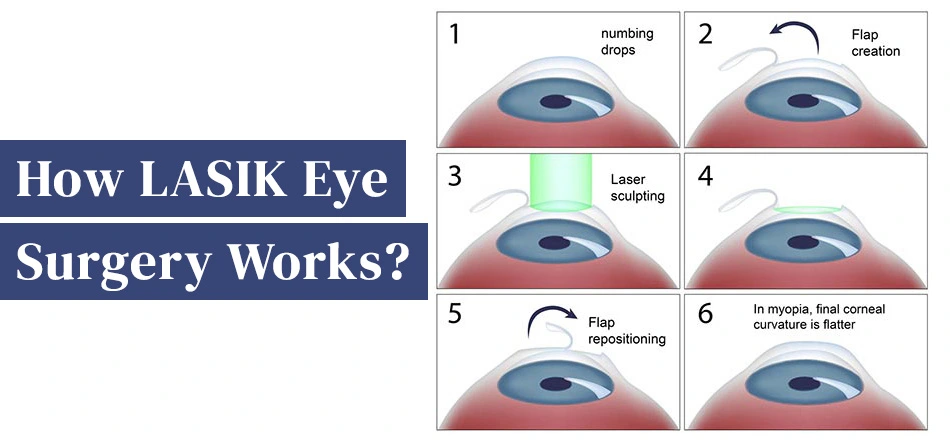 How LASIK Eye Surgery Works