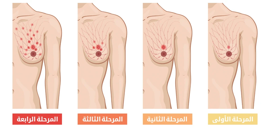 معدلات البقاء على قيد الحياة لسرطان الثدي حسب المرحلة