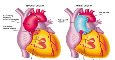 Концентрированное сердце Хирургия ASD и закрытие VSD
