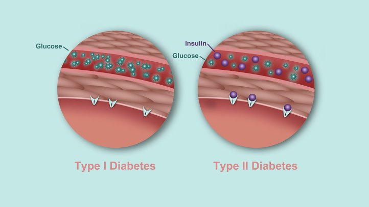 Диабет Тип 1 и 2