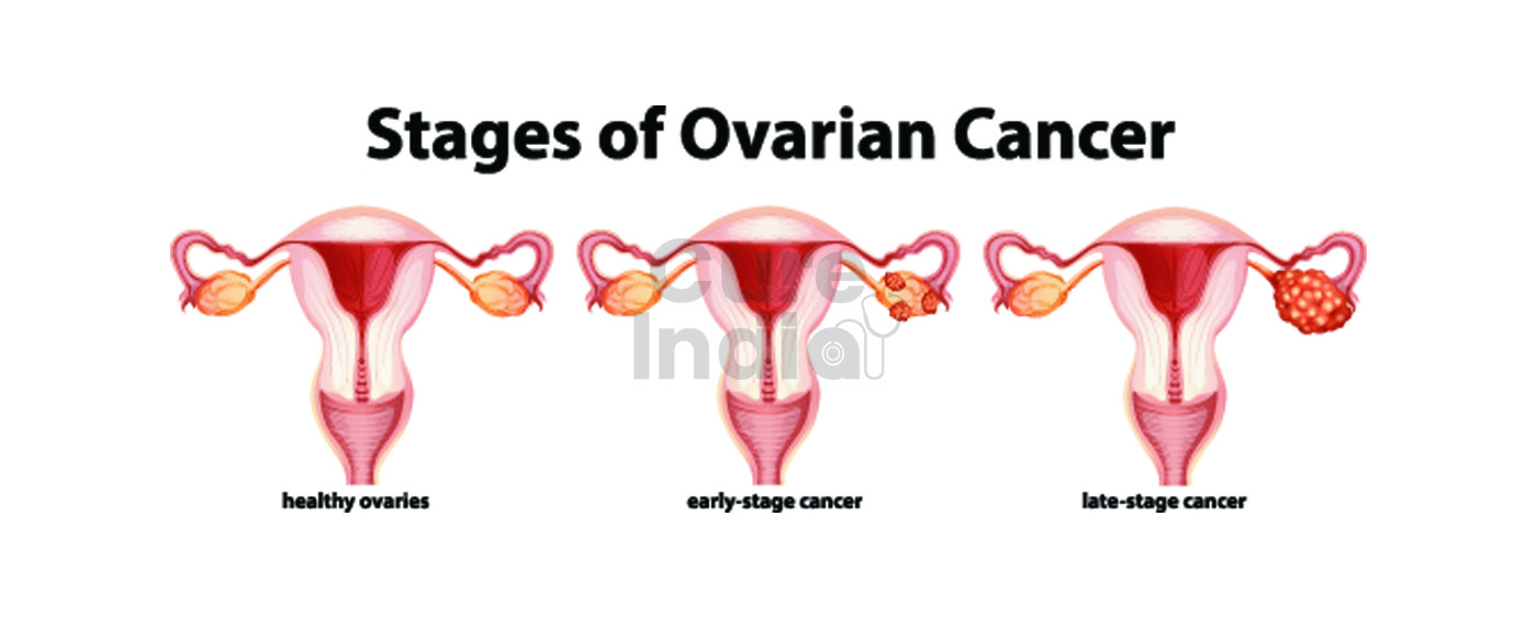 Ovarian Cancer Treatment in India