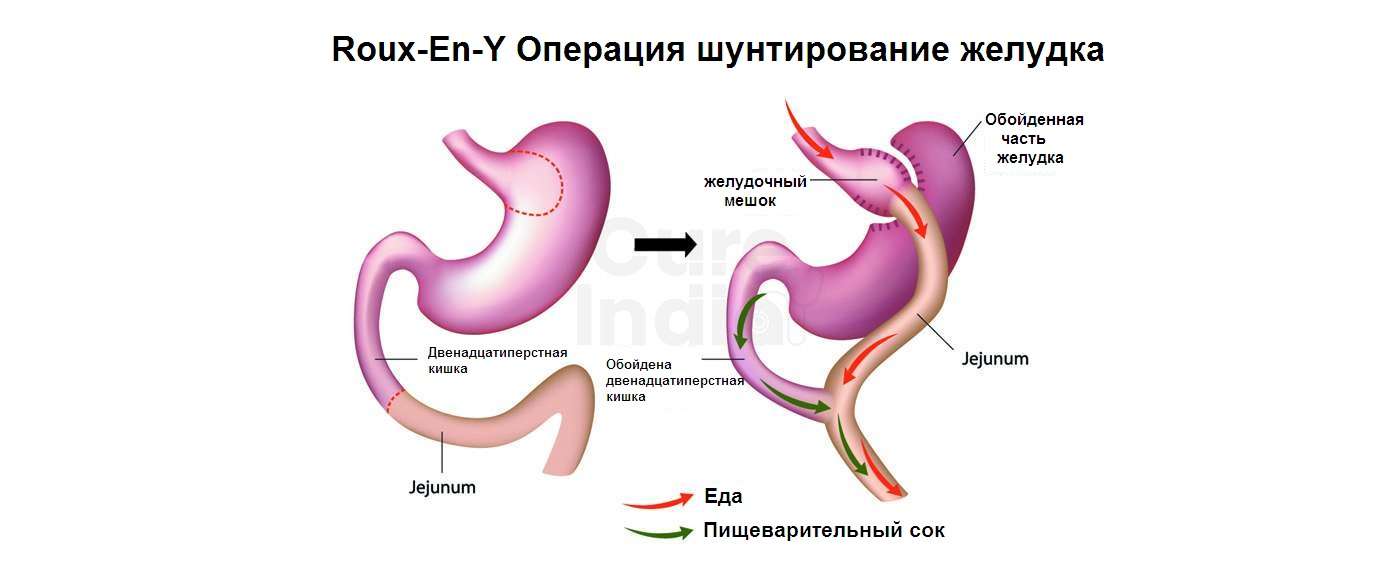 Витамины после бариатрической операции. Витамины после бариатрической операции