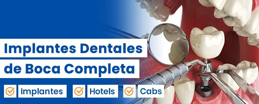 Implantes Dentales De Boca Completa
