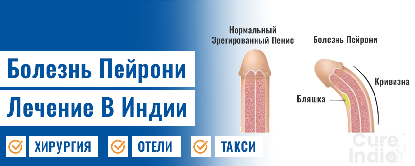 Болезнь Пейрони Лечение