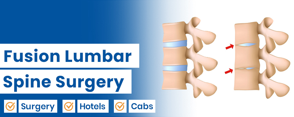 Fusion Lumbar Spine Surgery