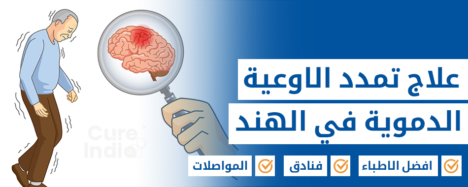 علاج تمدد الأوعية الدموية في الدماغ