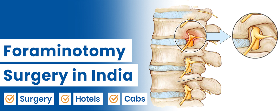 Foraminotomy Surgery
