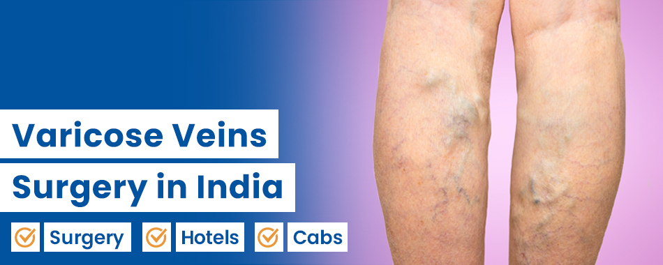 Varicose Vein Surgery