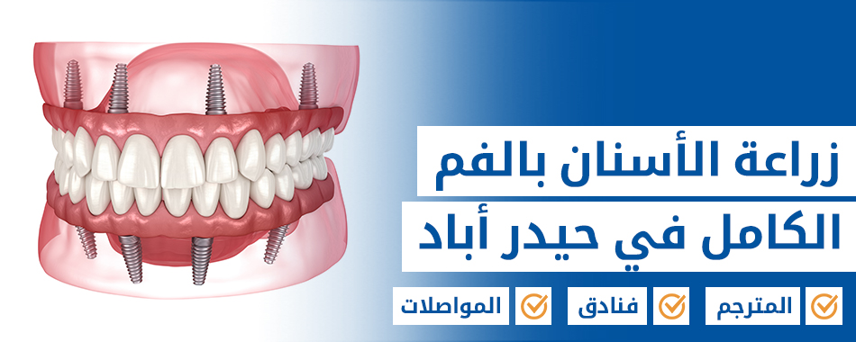 زراعة الأسنان بالفم الكامل