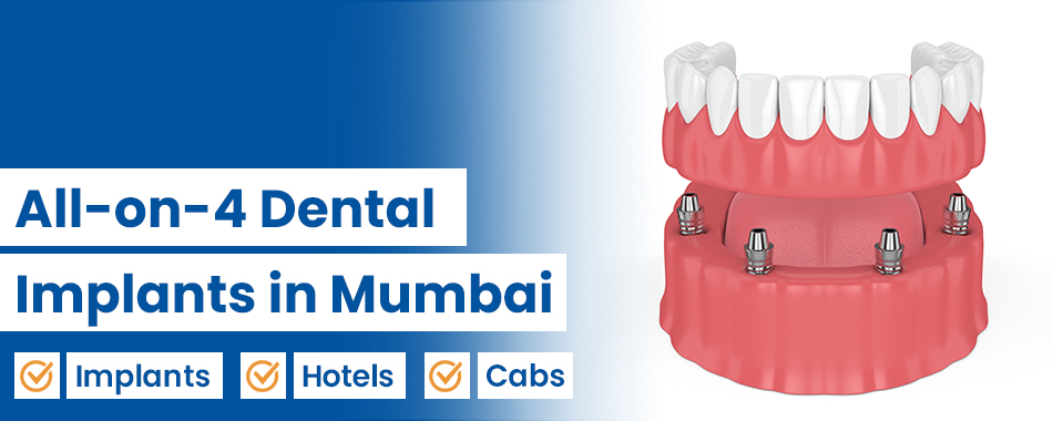 All-on-4 Dental Implants in Mumbai