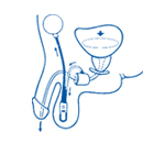 العضلة العاصرة البولية ams 800